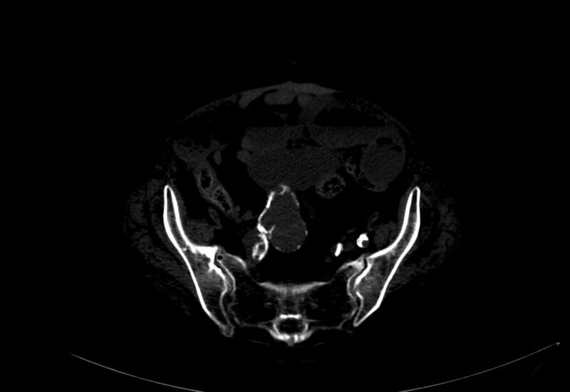 File:Abdominal aortic aneurysm - impending rupture (Radiopaedia 19233-19246 B 47).jpg