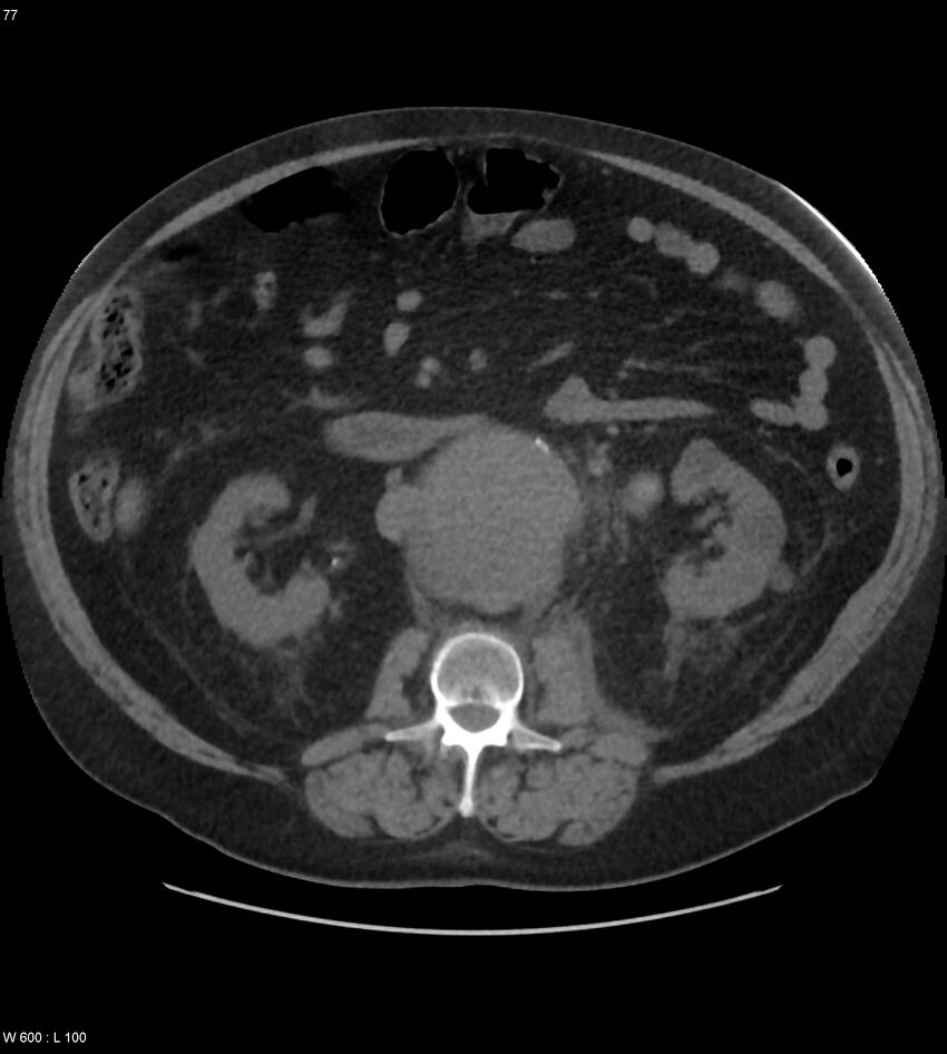 Abdominal aortic aneurysm with intramural hematoma then rupture (Radiopaedia 50278-55631 Axial non-contrast 73).jpg