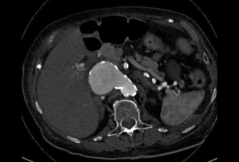 File:Abdominal aortic aneurysm with thrombus fissuration (Radiopaedia 73192-83919 Axial C+ arterial phase 39).jpg