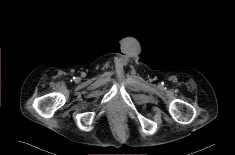 File:Abdominal aortic interposition tube graft and aneurysm thrombosis (Radiopaedia 71438-81857 Axial C+ arterial phase 264).jpg