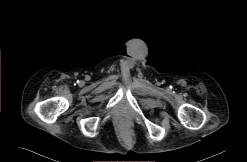 Abdominal aortic interposition tube graft and aneurysm thrombosis (Radiopaedia 71438-81857 Axial C+ arterial phase 264).jpg