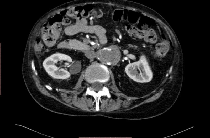 File:Abdominal aortic interposition tube graft and aneurysm thrombosis (Radiopaedia 71438-81857 Axial C+ arterial phase 56).jpg
