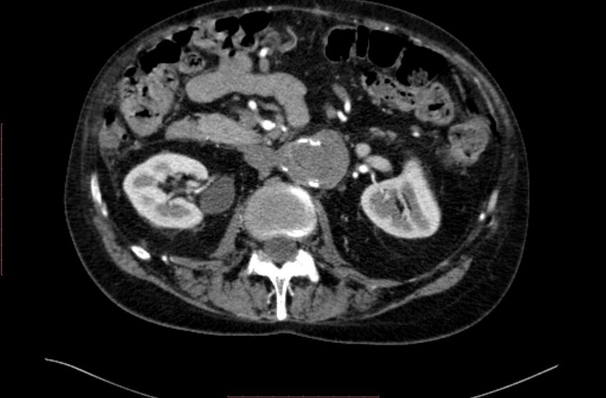 Abdominal aortic interposition tube graft and aneurysm thrombosis (Radiopaedia 71438-81857 Axial C+ arterial phase 56).jpg