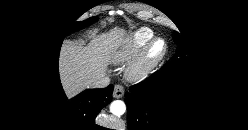 File:Aberrant left main coronary artery (ALMCA) arising from the right sinus with interarterial course (Radiopaedia 63251-71814 Axial C+ arterial phase 175).JPG