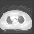 Aberrant left pulmonary artery (pulmonary sling) (Radiopaedia 42323-45435 Axial lung window 9).jpg