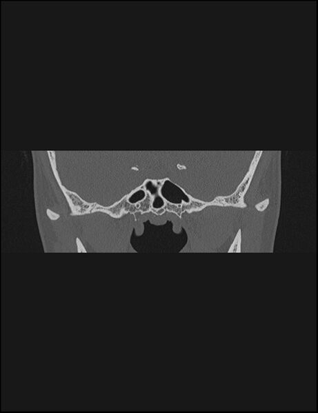File:Aberrant right internal carotid artery (Radiopaedia 65191-74198 Coronal non-contrast 4).jpg