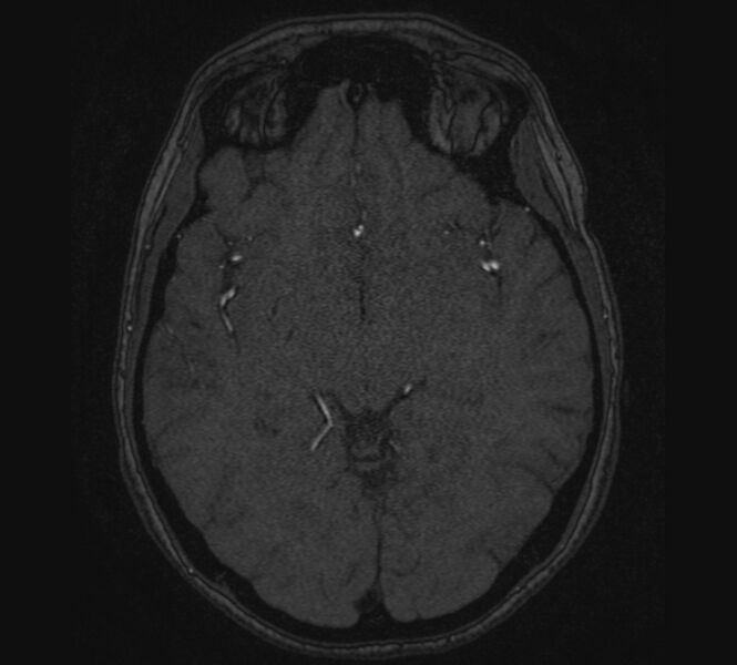 File:Accessory middle cerebral artery and ICA aneurysm (Radiopaedia 22656-22674 MRA 64).jpg