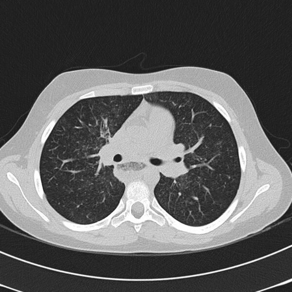 File:Achalasia (Radiopaedia 14946-14878 Axial lung window 31).jpg