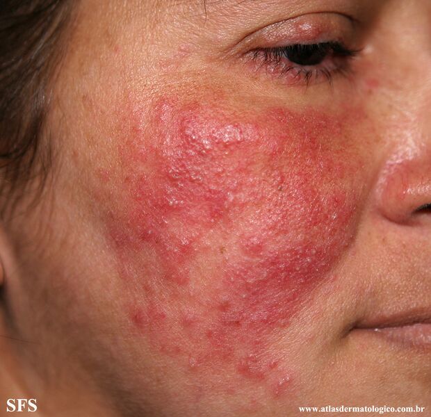 File:Acne Rosacea (Dermatology Atlas 22).jpg