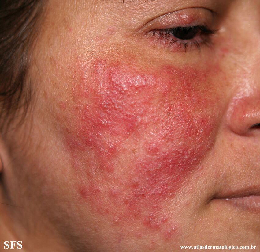 Acne Rosacea (Dermatology Atlas 22).jpg