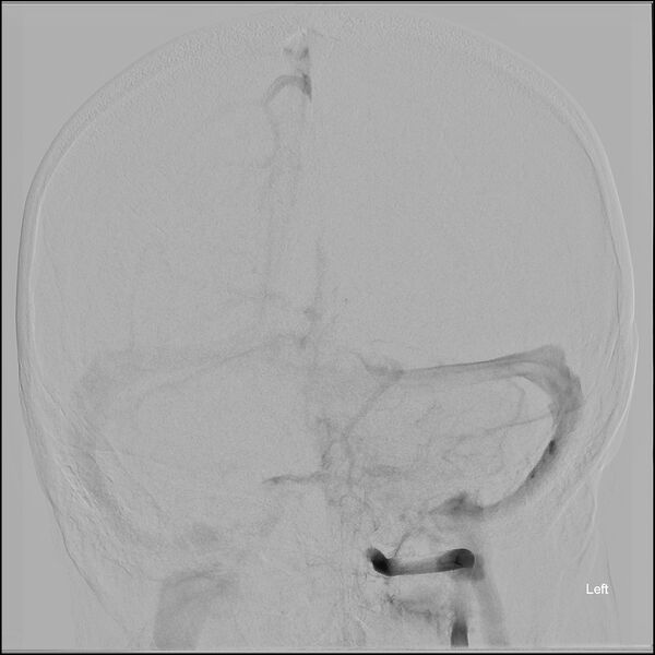 File:Acute P1 occlusion with PCA ischemia penumbra (CT perfusion) (Radiopaedia 72084-82589 Pre ECR frontal - Left VA injection 14).jpg
