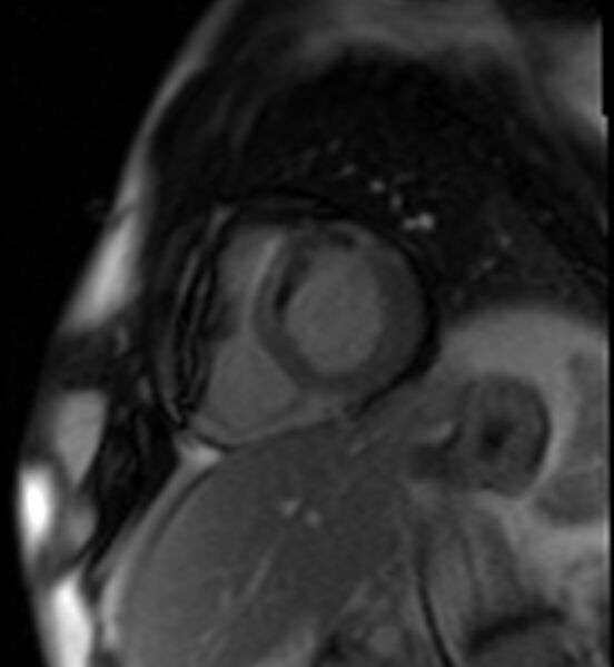 File:Acute anteroseptal myocardial infarction (Radiopaedia 68409-77945 Short axis (basal) Perfusion 43).jpg