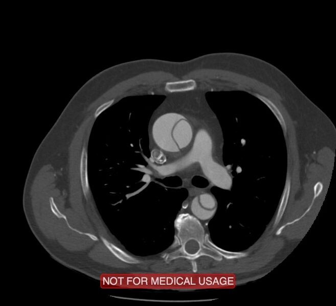 File:Acute aortic dissection - Stanford type A (Radiopaedia 40661-43285 Axial C+ arterial phase 21).jpg