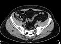 Acute appendicitis (Radiopaedia 13030-13091 Axial non-contrast 60).jpg