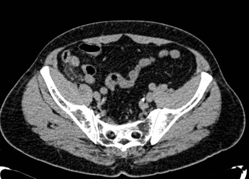 File:Acute appendicitis (Radiopaedia 13030-13091 Axial non-contrast 60).jpg