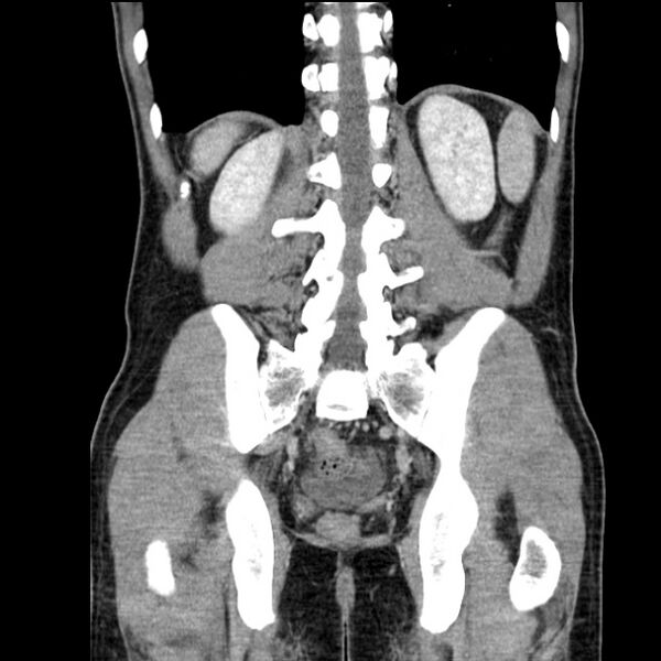 File:Acute appendicitis (Radiopaedia 27049-27227 Coronal C+ portal venous phase 43).jpg