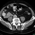 Acute appendicitis arising from a malrotated cecum (Radiopaedia 19970-19997 Axial C+ portal venous phase 26).jpg