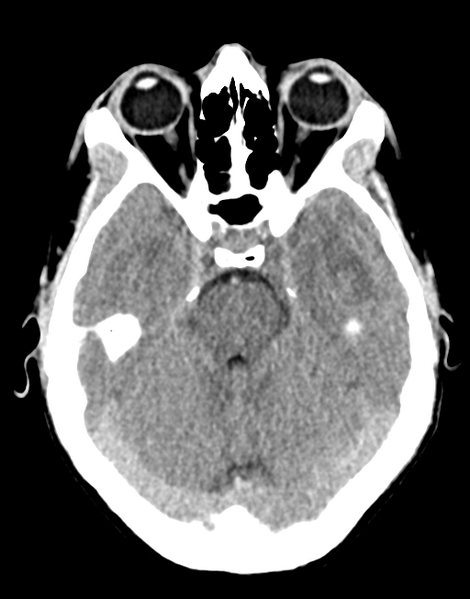 File:Acute disseminated encephalomyelitis (ADEM) (Radiopaedia 65319-74348 Axial non-contrast 11).png