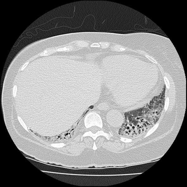 File:Acute interstitial pneumonitis (Radiopaedia 45404-49452 Axial lung window 73).jpg