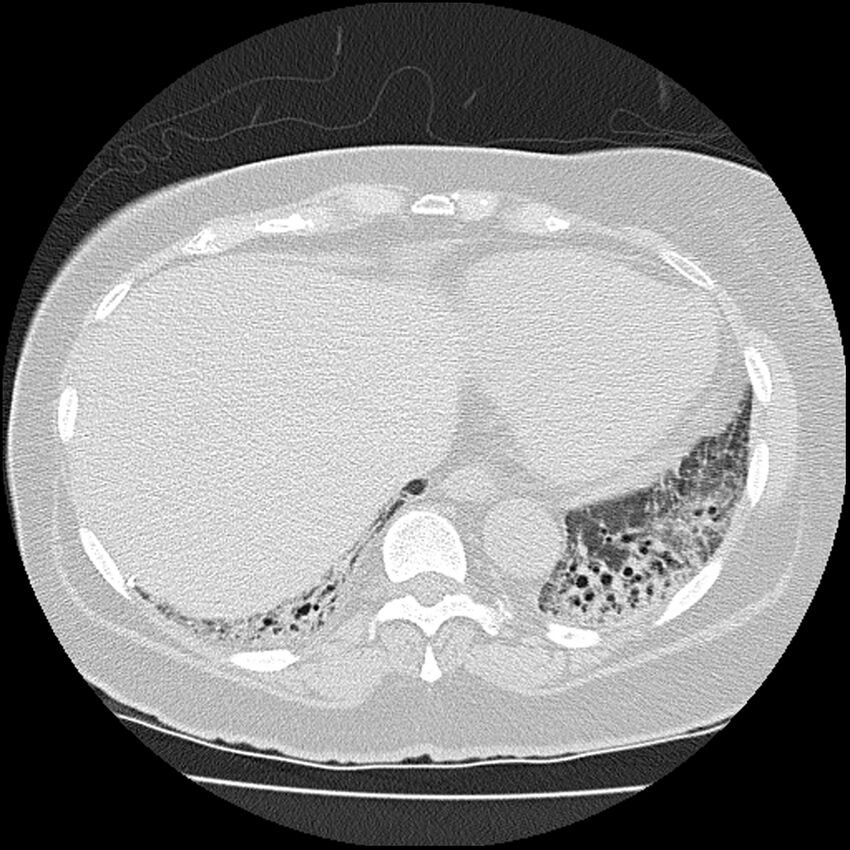 Acute interstitial pneumonitis (Radiopaedia 45404-49452 Axial lung window 73).jpg