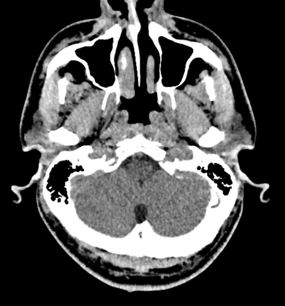 File:Acute ischemic stroke - posterior circulation territory (Radiopaedia 77670-89881 non-contrast 10).jpg