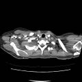 Acute myocarditis (Radiopaedia 55988-62613 C 11).jpg