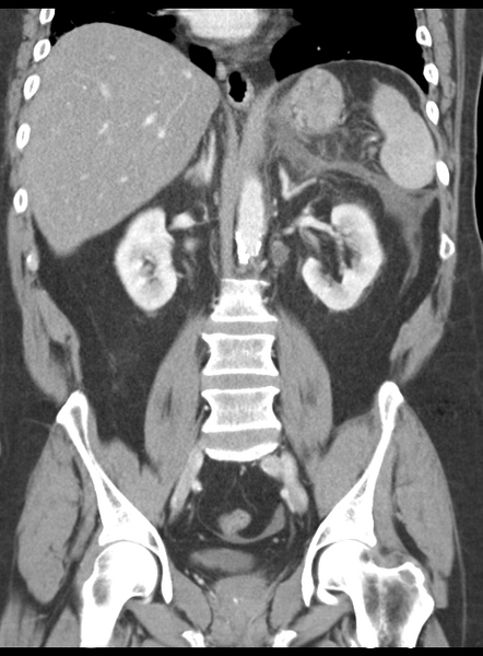 File:Acute pancreatitis complicated by portal vein thrombus (Radiopaedia 48148-52990 Coronal C+ portal venous phase 39).png