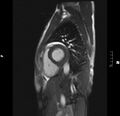 Acute perimyocarditis (Radiopaedia 48034-52833 Sagittal TRUFI CINE SHORT AXIS 81).JPG