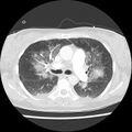 Acute pulmonary edema on CT (Radiopaedia 33582-34672 Axial lung window 20).jpg