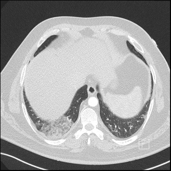 File:Acute pulmonary embolism with pulmonary infarct (Radiopaedia 73062-83768 Axial lung window 19).jpg