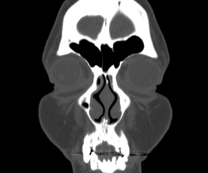 File:Acute sinusitis (Radiopaedia 22419-22455 Coronal bone window 6).jpg