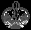 Acute sinusitis (Radiopaedia 23161-23215 Axial bone window 22).jpg