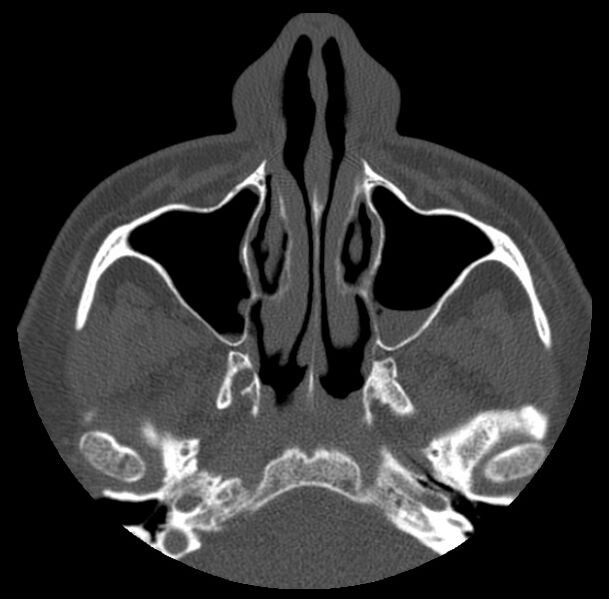 File:Acute sinusitis (Radiopaedia 23161-23215 Axial bone window 22).jpg