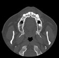 Acute sinusitis (Radiopaedia 23161-23215 Axial bone window 6).jpg