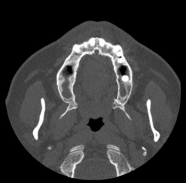 File:Acute sinusitis (Radiopaedia 23161-23215 Axial bone window 6).jpg