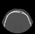 Acute sinusitis (Radiopaedia 23161-23215 Axial bone window 80).jpg