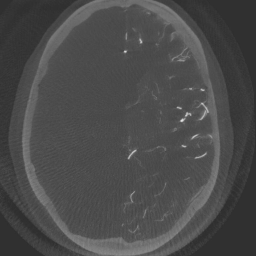 Acute subarachnoid hemorrhage and accessory anterior cerebral artery (Radiopaedia 69231-79010 C 37).jpg