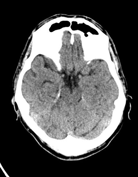 File:Acute superior cerebellar artery territory infarct (Radiopaedia 84104-99359 Axial non-contrast 45).jpg