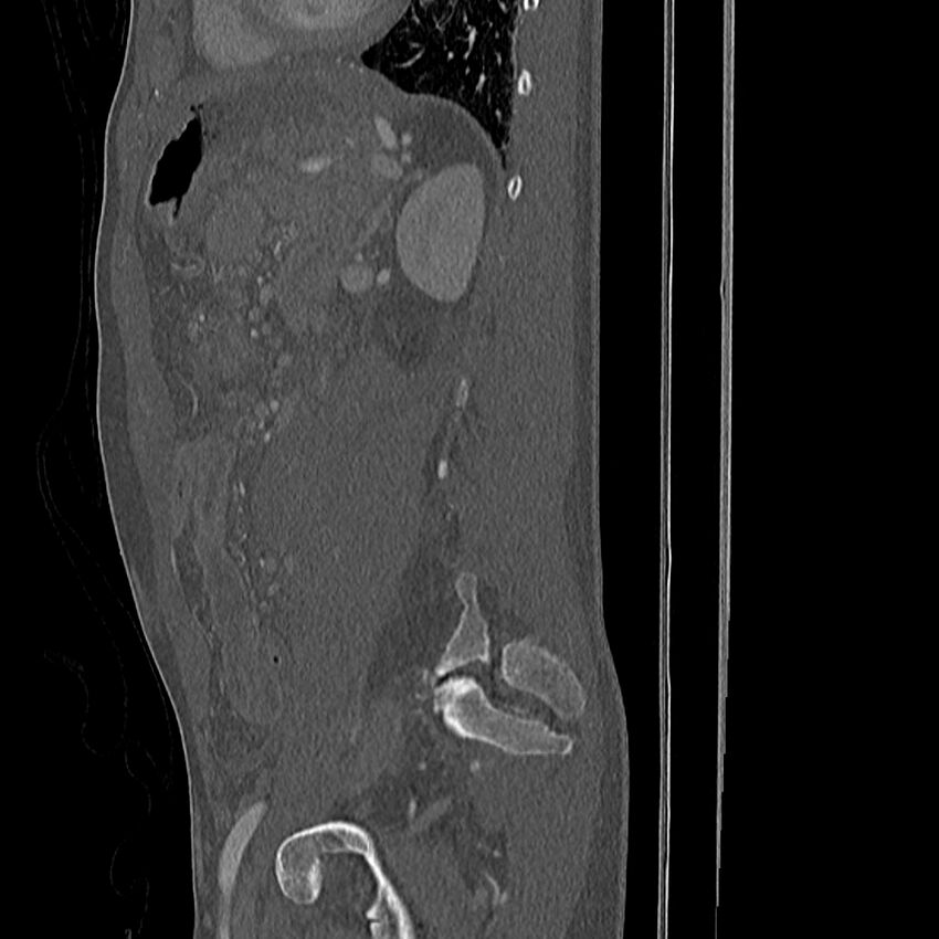 Acute vertebral body compression fractures (Radiopaedia 31757-32693 Sagittal bone window 4).jpg