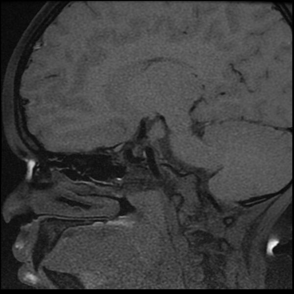 File:Adamantinomatous craniopharyngioma (Radiopaedia 77407-89529 Sagittal T1 fat sat 3).jpg