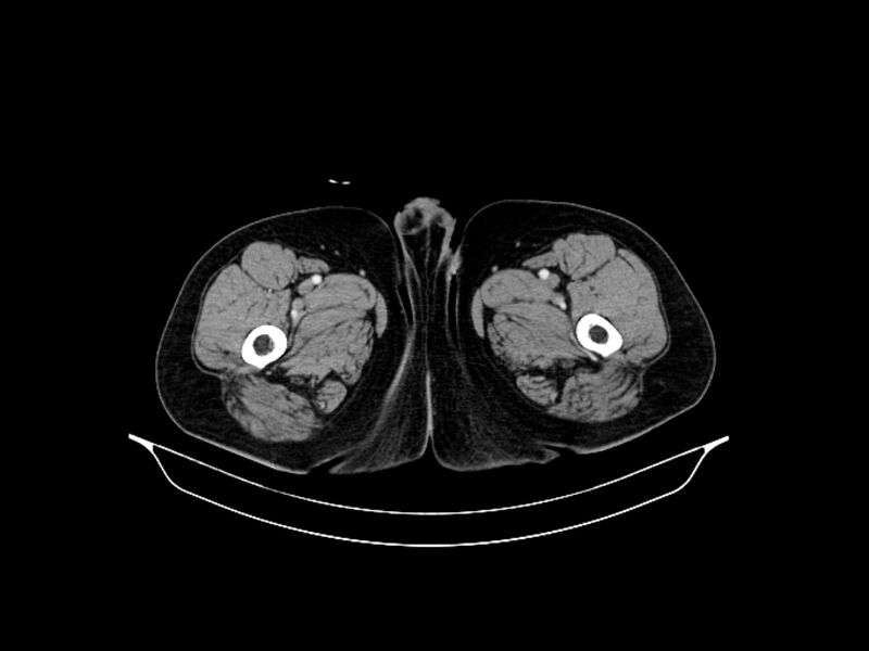 File:Adenocarcinoma of pancreas with hepatic metastasis (Radiopaedia 64332-73122 Axial C+ portal venous phase 116).jpg