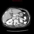 Adenocarcinoma of the colon (Radiopaedia 8191-9039 Axial liver window 25).jpg