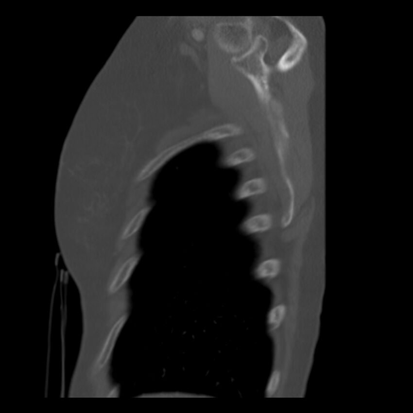 Adenocarcinoma of the lung (Radiopaedia 41015-43755 Sagittal bone window 101).jpg