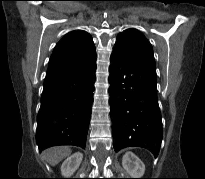 File:Adenocarcinoma of the lung (Radiopaedia 44205-47803 Coronal C+ portal venous phase 74).jpg