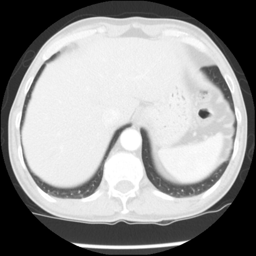 Adenocarcinoma of the lung - micropapillary predominant (Radiopaedia 42446-45563 Axial lung window 65).jpg