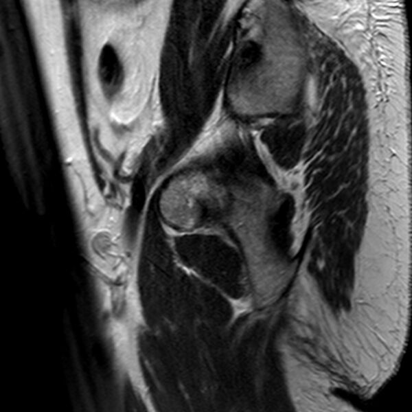 File:Adenomyoma of the uterus (Radiopaedia 9871-10439 Sagittal T2 2).jpg