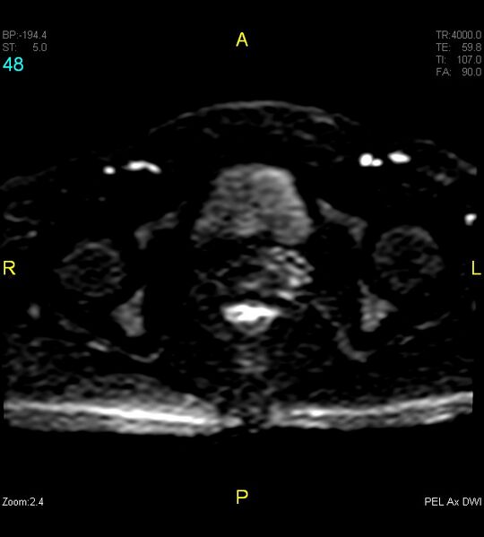 File:Adenomyosis (Radiopaedia 43504-46889 Axial DWI 48).jpg