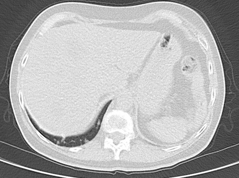 File:Adenosquamous lung carcinoma (Radiopaedia 22035-22030 lung window 55).jpg