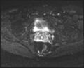 Adnexal multilocular cyst (O-RADS US 3- O-RADS MRI 3) (Radiopaedia 87426-103754 Axial DWI 18).jpg