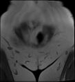 Adnexal multilocular cyst (O-RADS US 3- O-RADS MRI 3) (Radiopaedia 87426-103754 Coronal 2).jpg